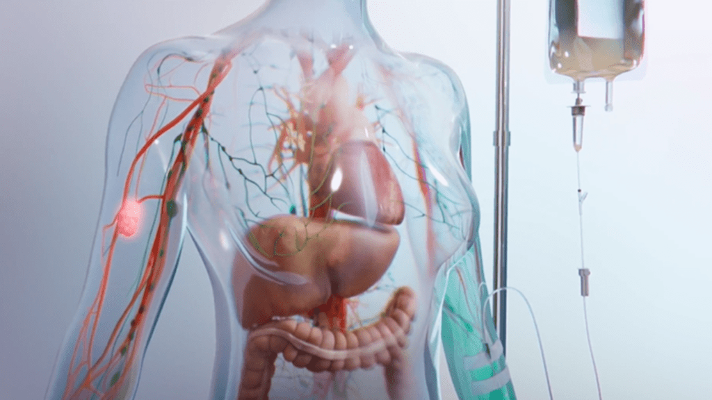 Transparent body with a tumor being treated with an IV bag.